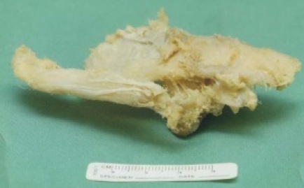 Mesh Infected hernia system